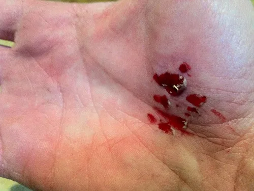 Scraped palm from the fall