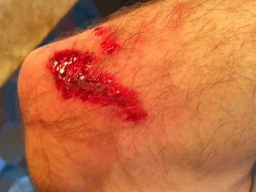 Scraped elbow from the fall
